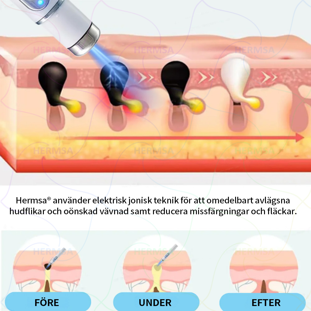 Hermsa® Non-Invasive Laser Pen - Mole and Wart Removal (🔥Last Day 80% OFF)