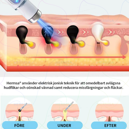 Hermsa® Non-Invasive Laser Pen - Mole and Wart Removal (🔥Last Day 80% OFF)